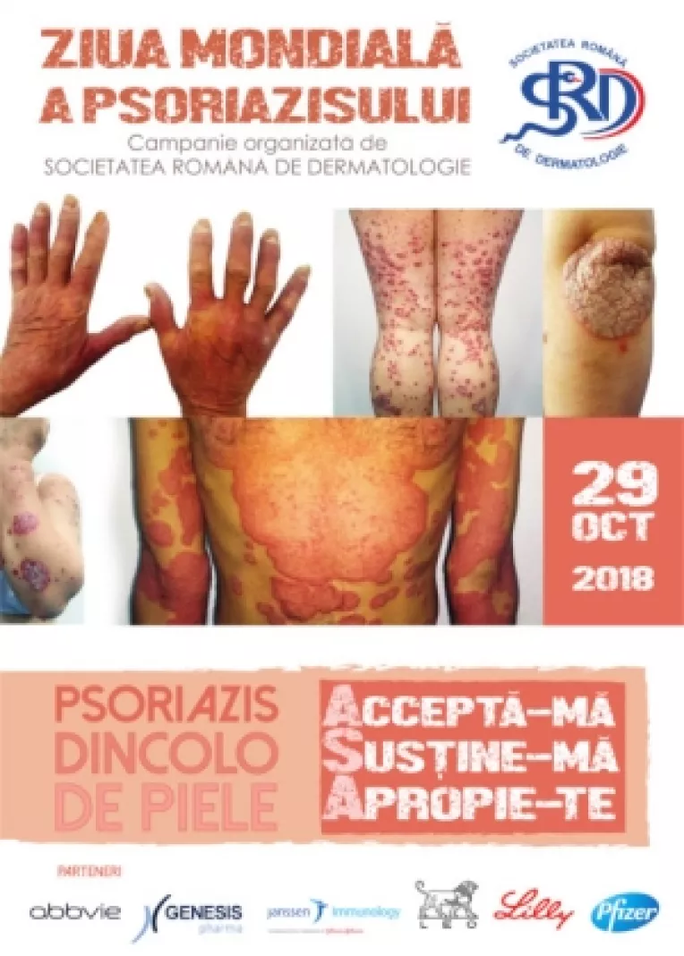 Psoriazisul a fost declarat de catre Organizatia Mondiala a Sanatatii (OMS) a 5-a cea mai grava boala cronica netransmisibila