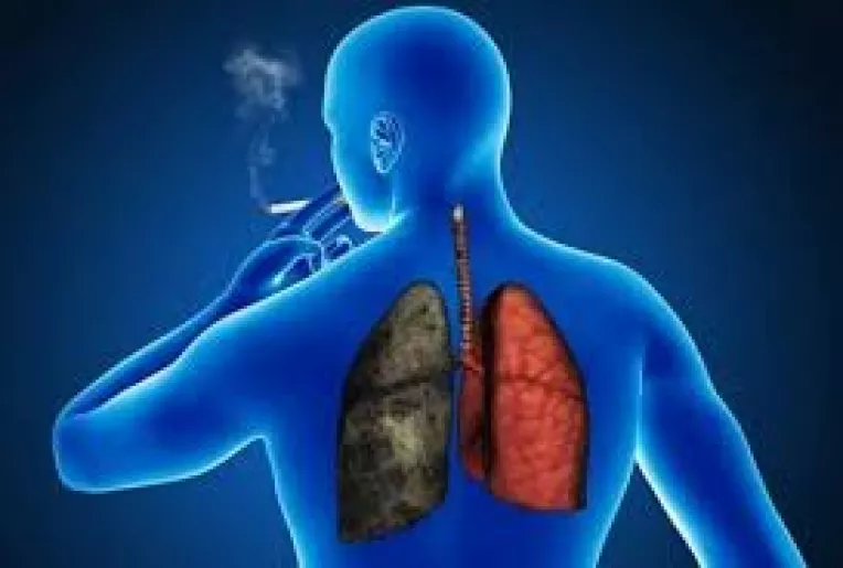 Scadere in greutate, raguseala, tuse cu sange, simptome ale cancerului pulmonar